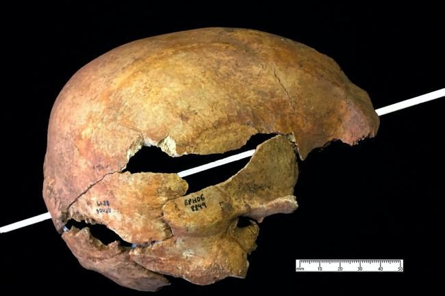 Medieval skull wound