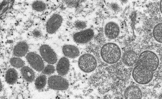 Microscopic view of the monkeypox virus