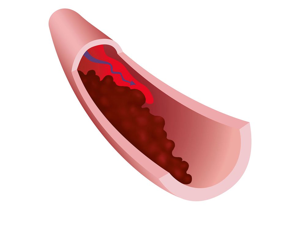 Why Blood Clots Are a Major Problem in Severe Covid-19