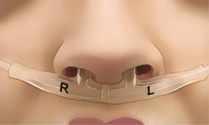 an illustration of a tube in a person's nose