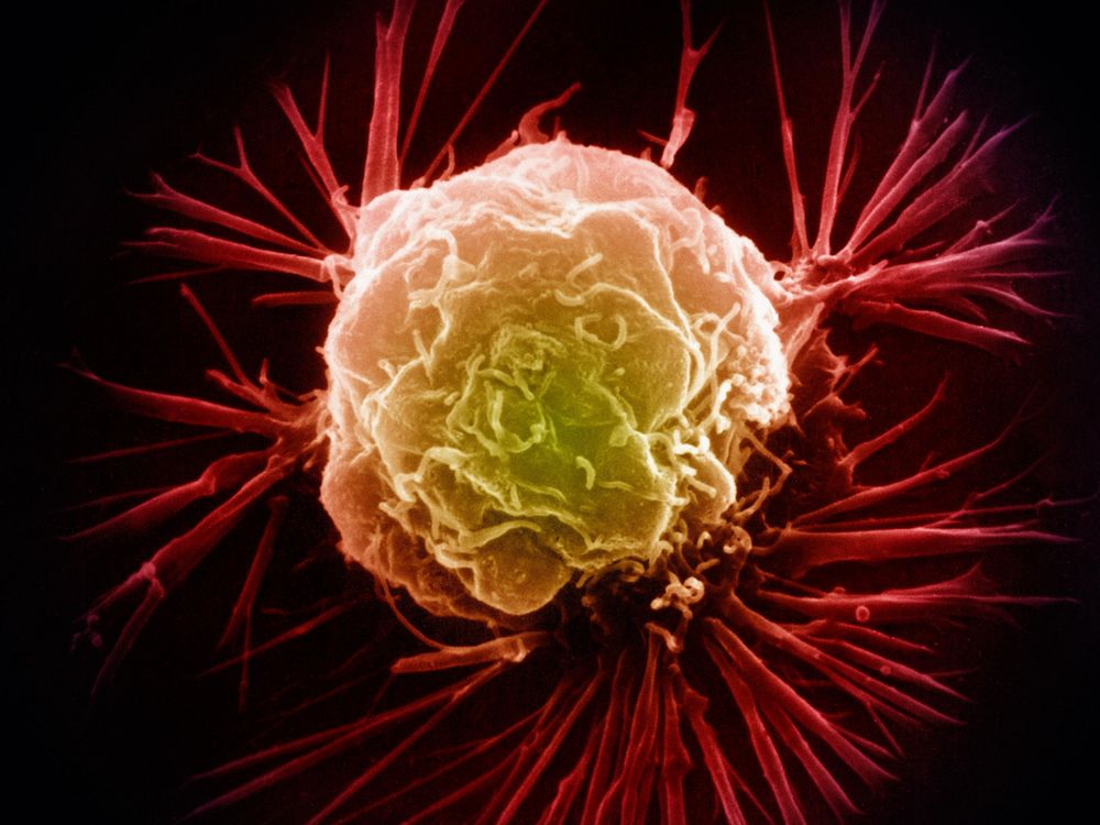 Breast Cancer Cell