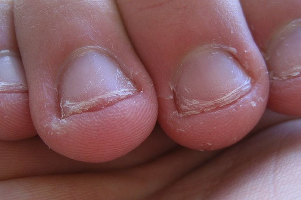 20121101015014nail-biting.jpg