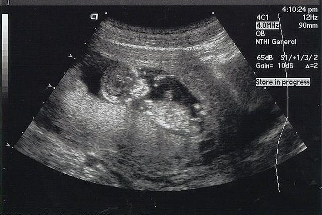 A mother’s DNA contains enough information to sequence a fetal genome.