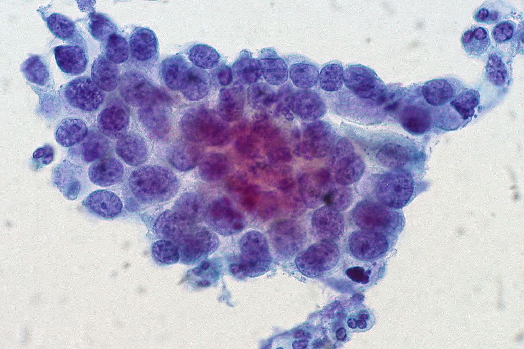 Cervical Cancer