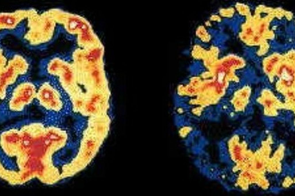 What a deteriorating brain looks like