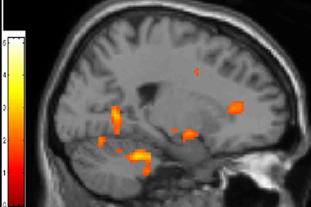 The orange dot on the right is the anterior cingulate cortex.
