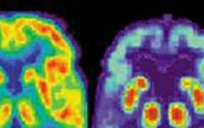 The brain scan on right shows Alzheimer’s damage.
