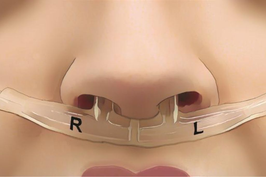 an illustration of a tube in a person's nose