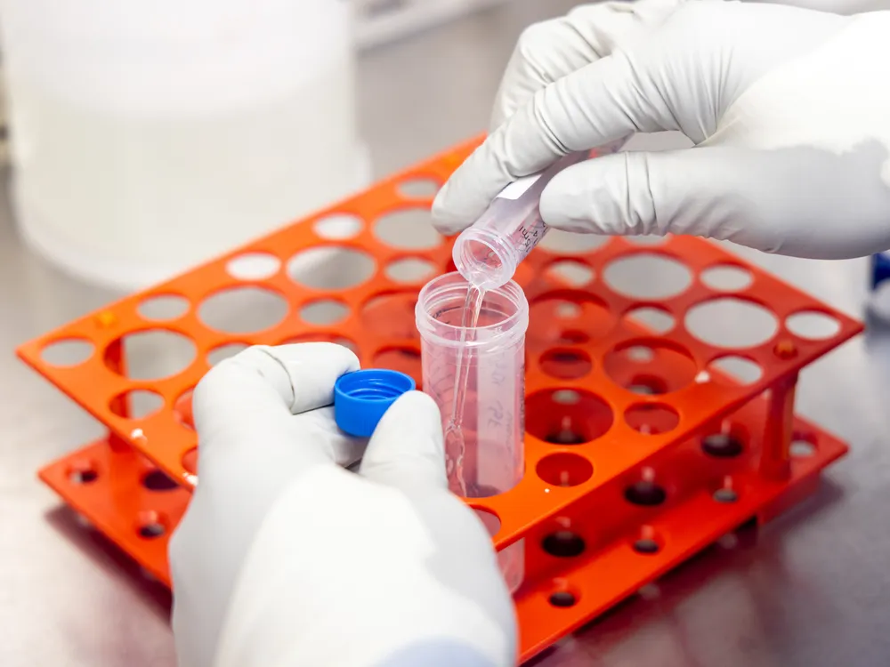 A sample of cerebrospinal fluid