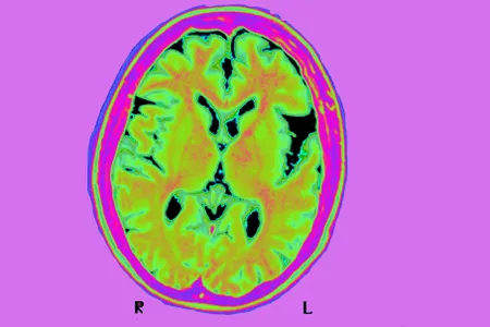 An MRI of the brain of a person with Alzheimer's not connected to the new study.