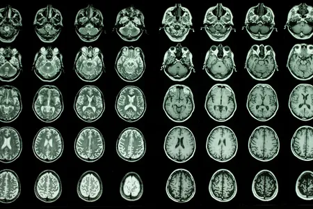 Researchers looked at brain scan data and results from blood tests to search for correlation between certain proteins and brain aging.