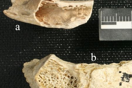 A Neanderthal rib bone was discovered to have a lesion associated with a tumor (top specimen). The missing bone tissue is starkly apparent compared to a normal Neanderthal rib shown below.