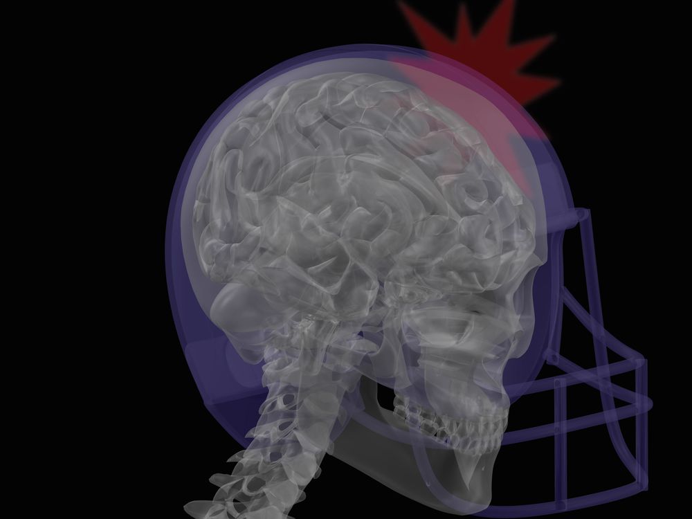 Football Concussion