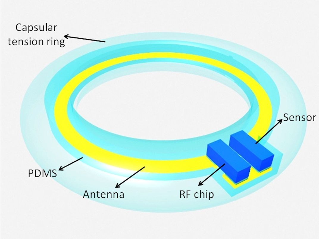 An Implantable Glaucoma Sensor