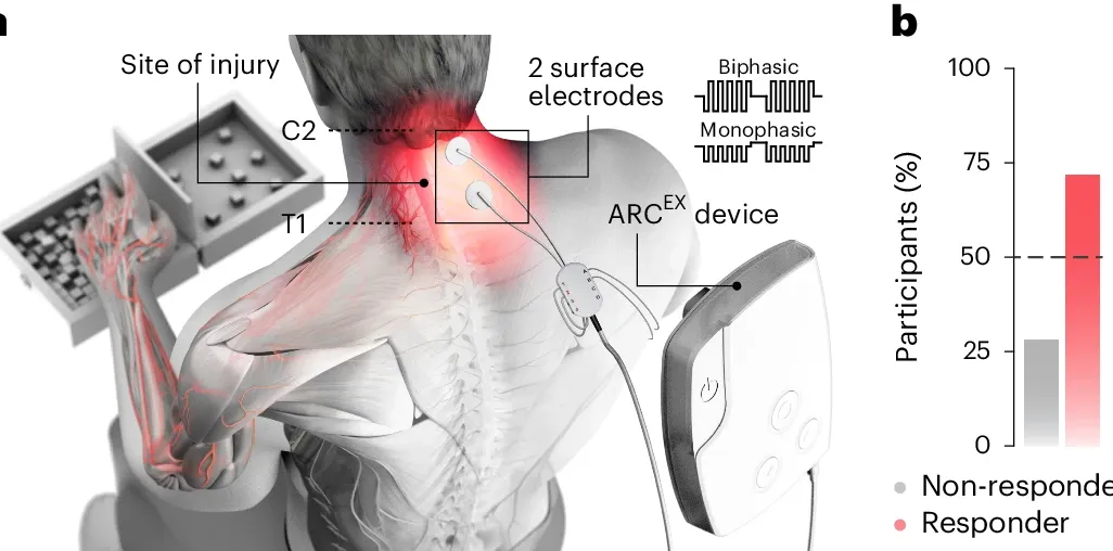 An artist's rendering shows where Arc-Ex is placed on a person's neck to stimulate electric pulses on their spinal cord.
