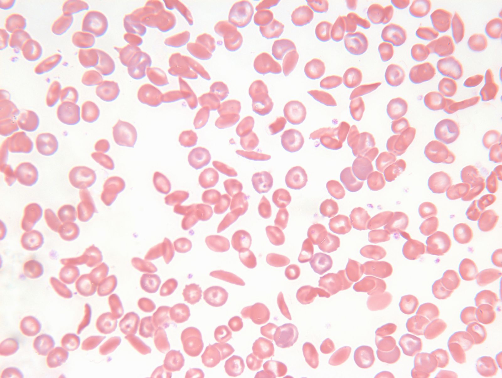 sickle cells
