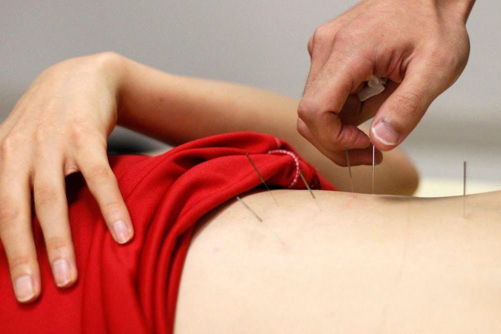 A South Koren athlete receives acupuncture treatment
