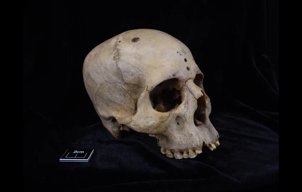 Egyptian Cancer Surgery Skull