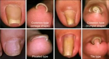 Curled Toe Nails? All About Pincer Nails and Ingrown Toenails