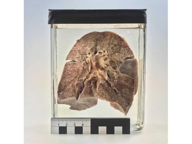 Measles lung