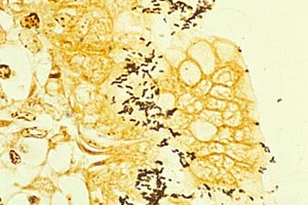 20110520090002ulcer_art.jpg