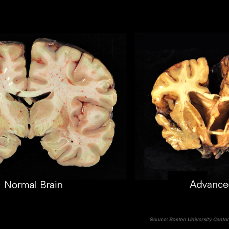 Study links college football with cognitive impairment, other health issues  