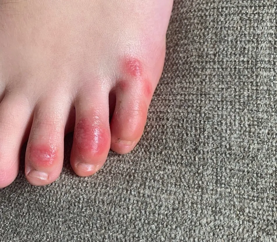 Image of left foot showing red skin irritation on small toes that resembles frost bite