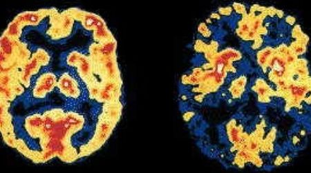 What a deteriorating brain looks like