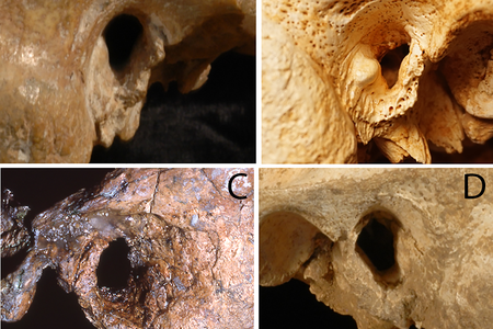 Surfer's Ear growths in Neanderthal ear canals.