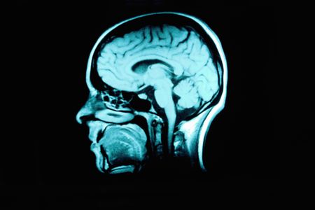 MRI scan of a brain