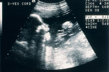 A sonogram of a human fetus.&nbsp;
