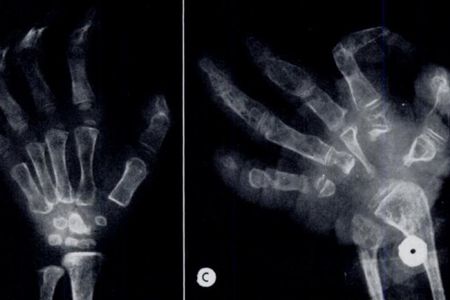 The X-ray on the left shows one of the girls’ hands at 2-and-a-half-years old. On the right, her same hand is shown at 12-years old.