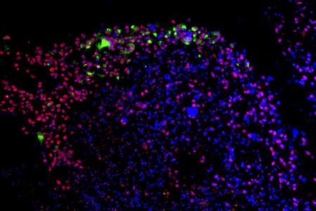 An image of cells showing Zika virus (highlighted green) targeting the cancerous stem cells (highlighted red) of a human glioblastoma tumor