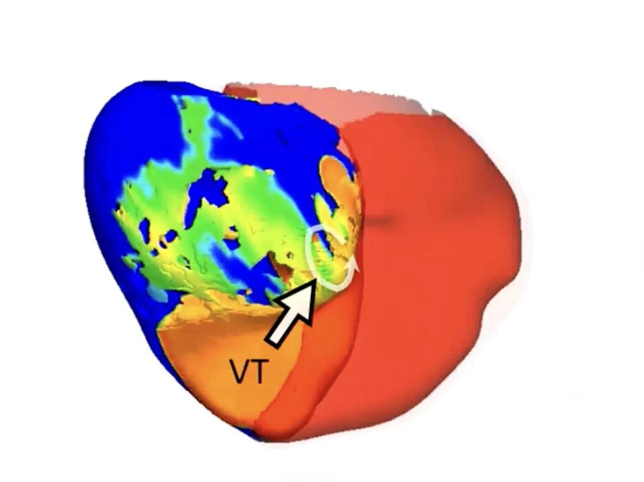 Doctors Used 'Digital Twins' of Patients' Hearts to Fix Their Irregular ...